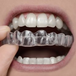 Essix retainer with tooth ada code