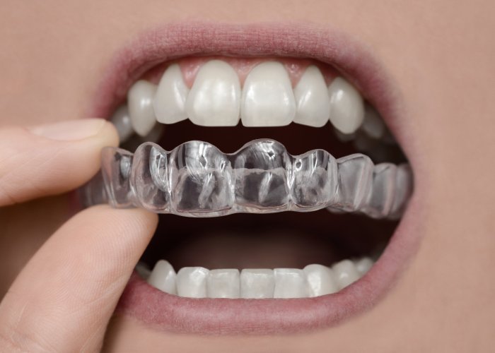 Essix retainer with tooth ada code