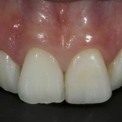 Composite posterior restorations conventional modified